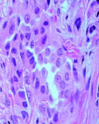 adenocarcinoma