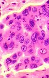 Types of Lung Cancers | Small Cell and Non-Small Cell Lung Cancer