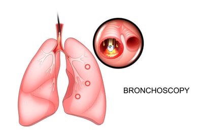 lung-cancer-bronchoscopy