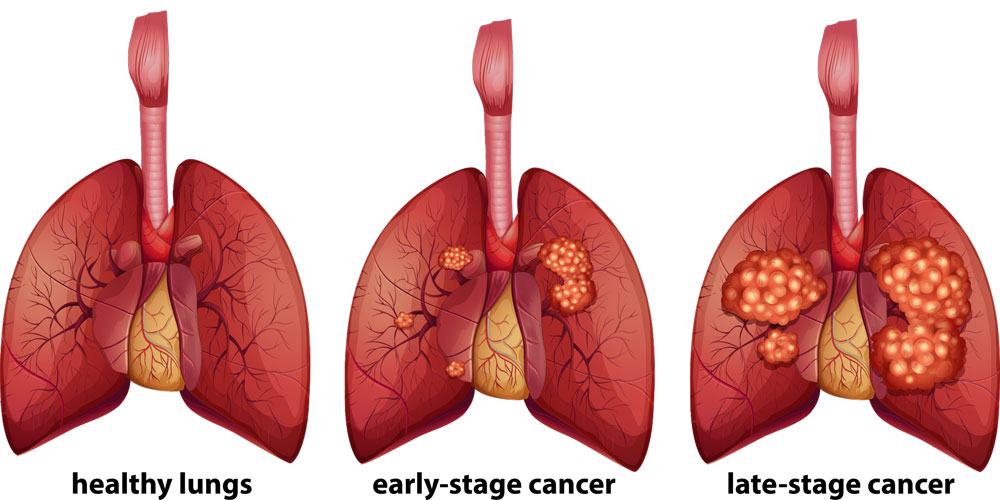 Staging of Lung Cancer Lung Cancer Stages