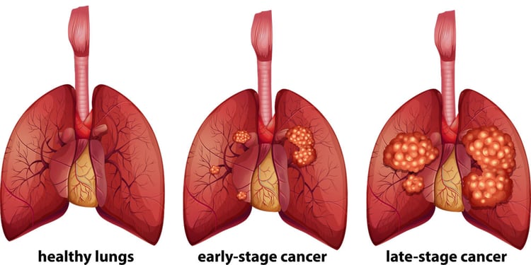 Staging Of Lung Cancer Lung Cancer Stages