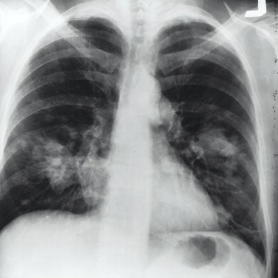 lung-cancer-x-ray